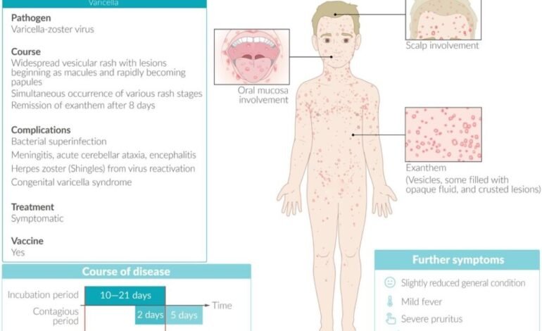 Increased cases of Chicken Pox Prompts Ministry of Health and Human Services Response